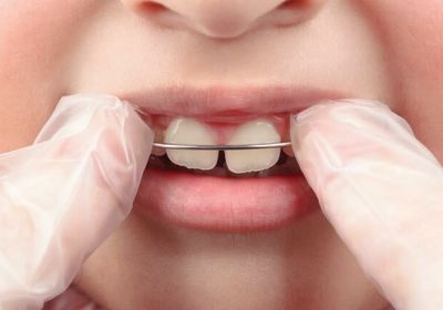 Class II Malocclusion in Children: Causes and Treatment in Bristol, Connecticut