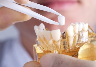 How Dental Implants Improve Oral Health