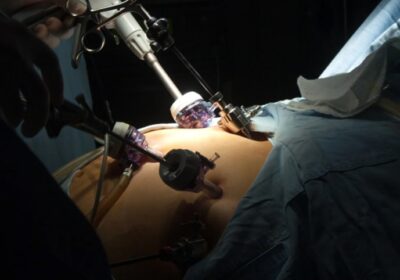 Top Questions to Ask Before Getting Gastric Sleeve Surgery