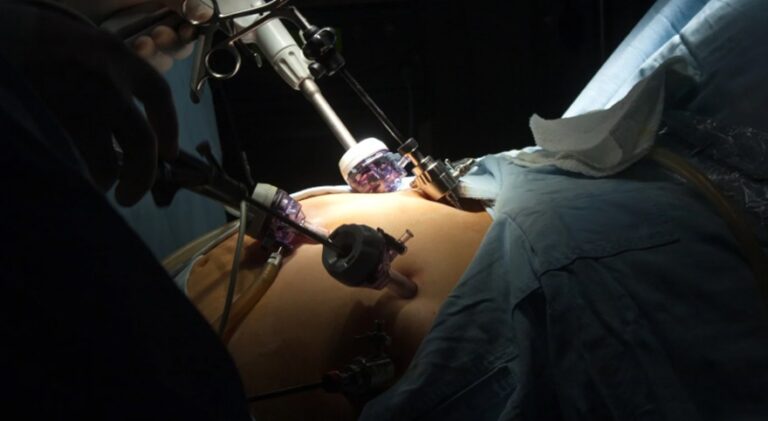 Getting Gastric Sleeve Surgery